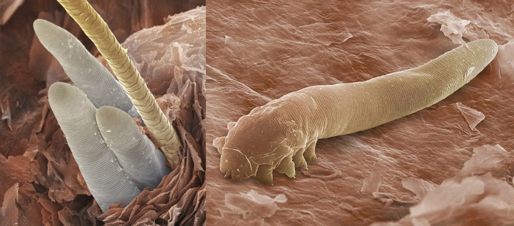 Blefarita DEMODEX