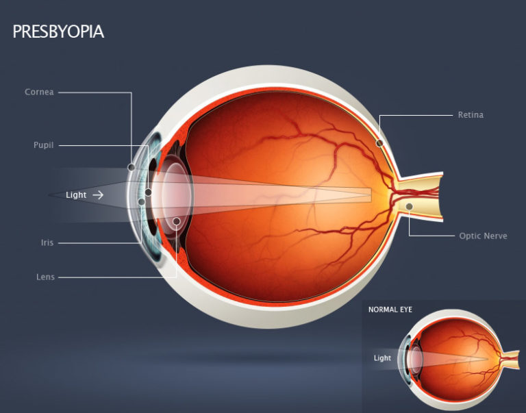 presbiopia