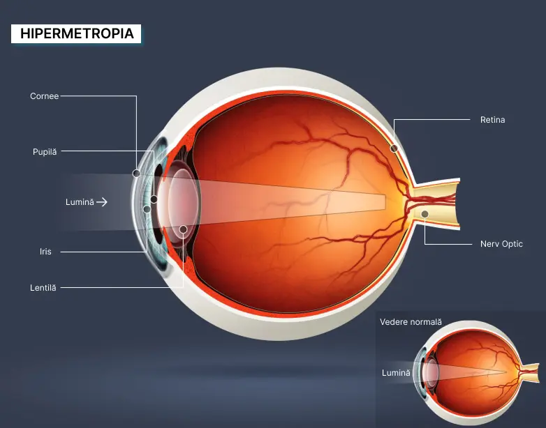 Diagrama explicativă a hipermetropiei: focalizarea imaginii în spatele retinei
