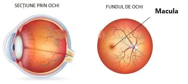 Degenerescența maculară legată de vârstă (DMLV)
